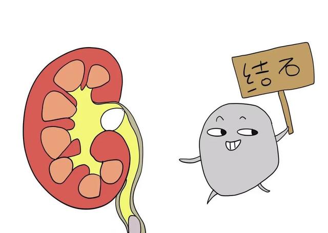 泌尿系结石治疗的"石话石说"|结石_新浪财经_新浪网