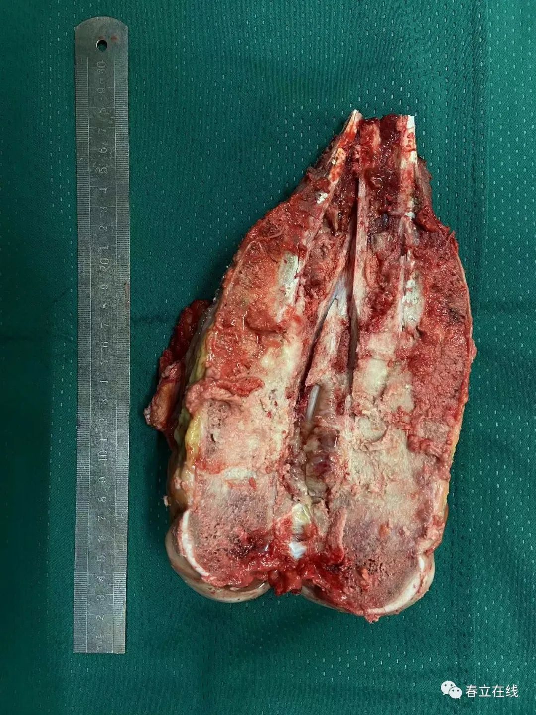 定制专家-挑战股骨下段骨肉瘤精准切除及个体化重建成功!