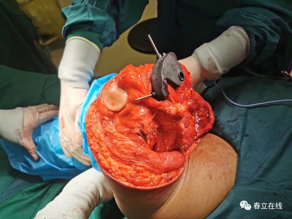 定制专家-挑战股骨下段骨肉瘤精准切除及个体化重建成功!