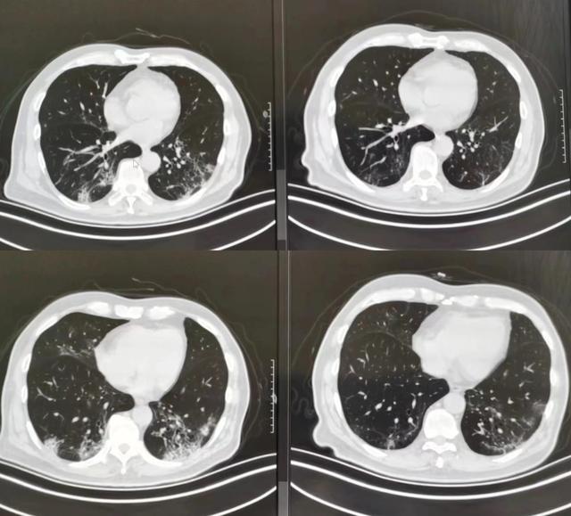 "阳康"后,ct查出肺部条索影,纤维灶到底要紧吗?胸科专家带来解答