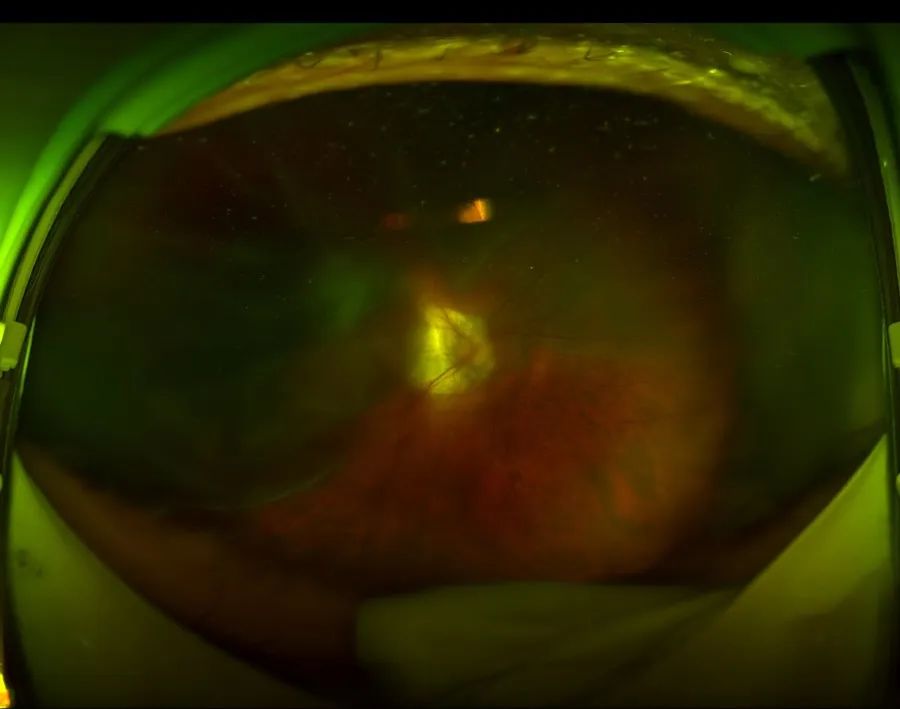 　　图:欧堡照相下的视网膜脱离