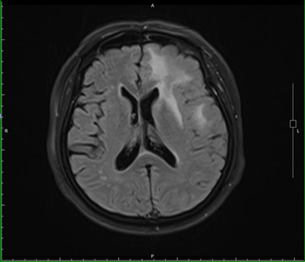 患者初诊时头颅磁共振.上海新华医院 供图