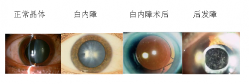 不少老年白内障患者在术后一段时间会出现视物不清的情况,这让他们很