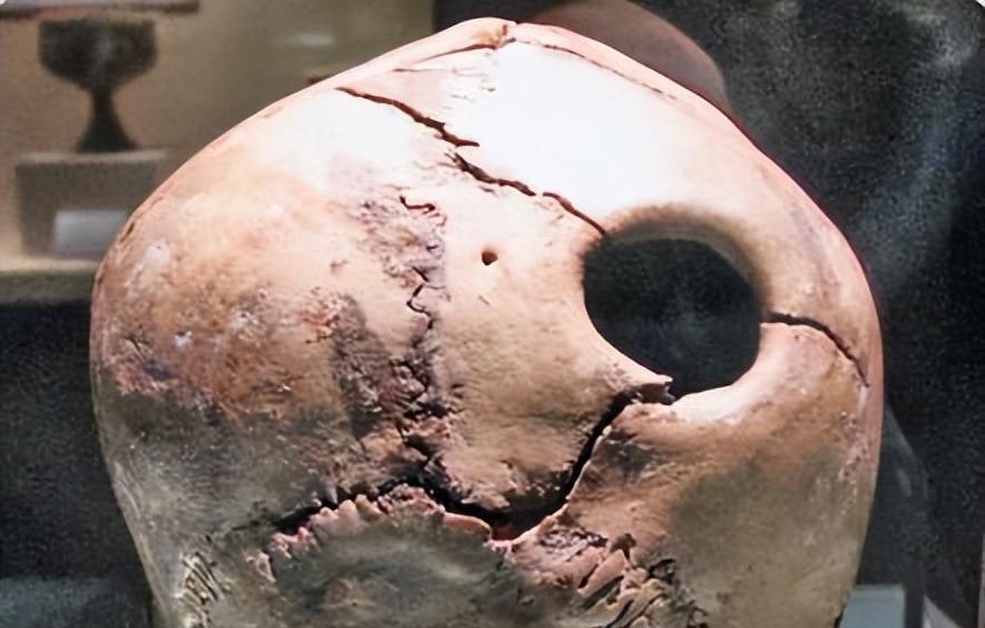 山东省东营市广饶傅家遗址出土颅骨上的近圆形缺损(图片来源:新华社)