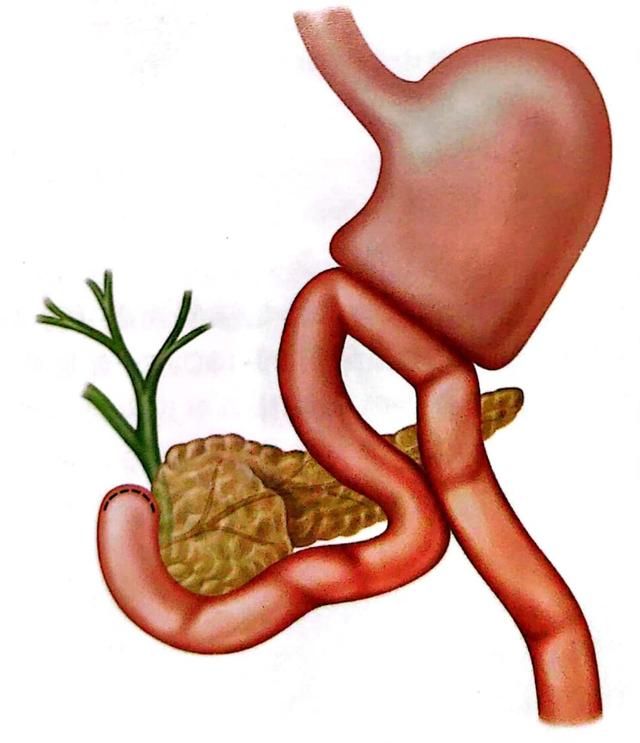 毕ii式加布朗吻合手术示意图