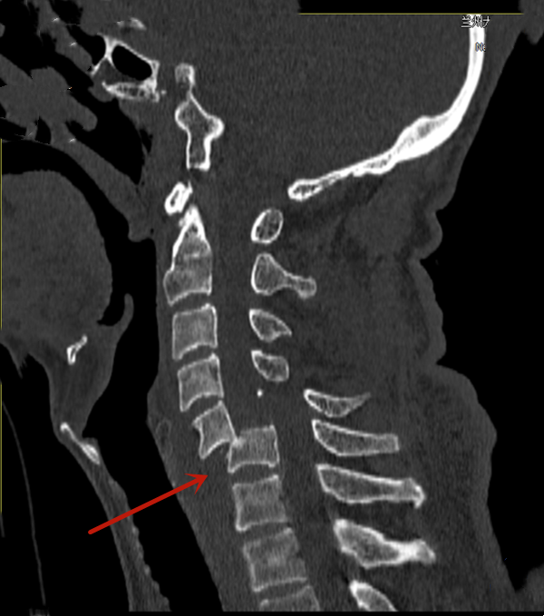 兰大二院急诊外科成功救治一例颈椎骨折并完全脱位患者|外科_新浪财经