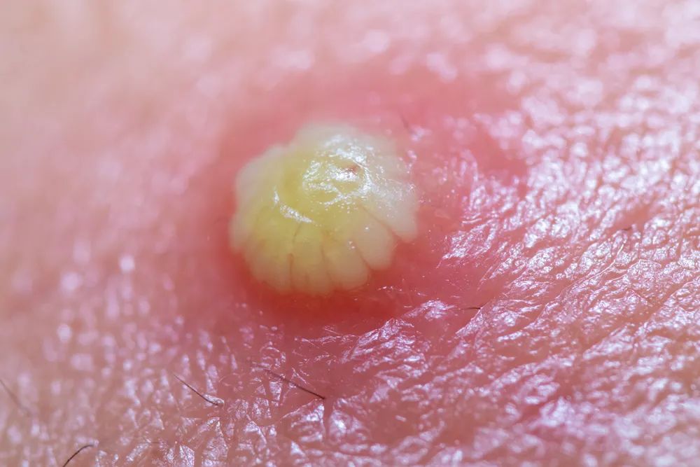 的小凸起,当心了,很可能是细菌感染导致的,这些小疙瘩可能是疖或者痈