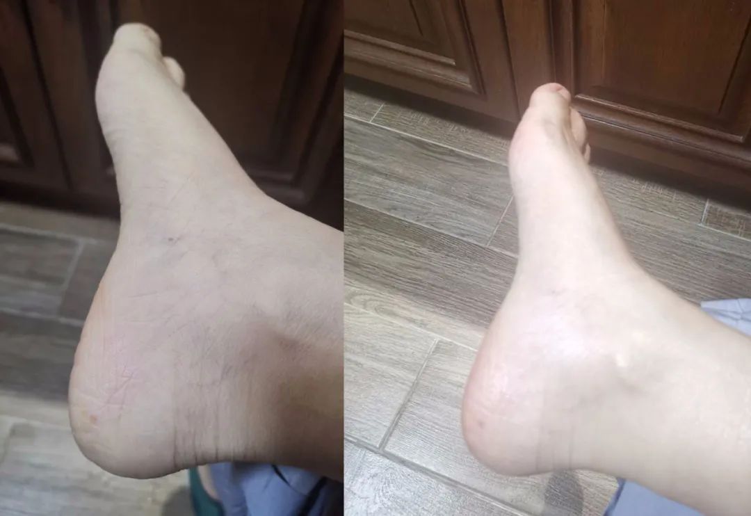 实拍脚后跟涂抹大白瓶前后对比,涂抹过后(右),肌肤滋润了不少