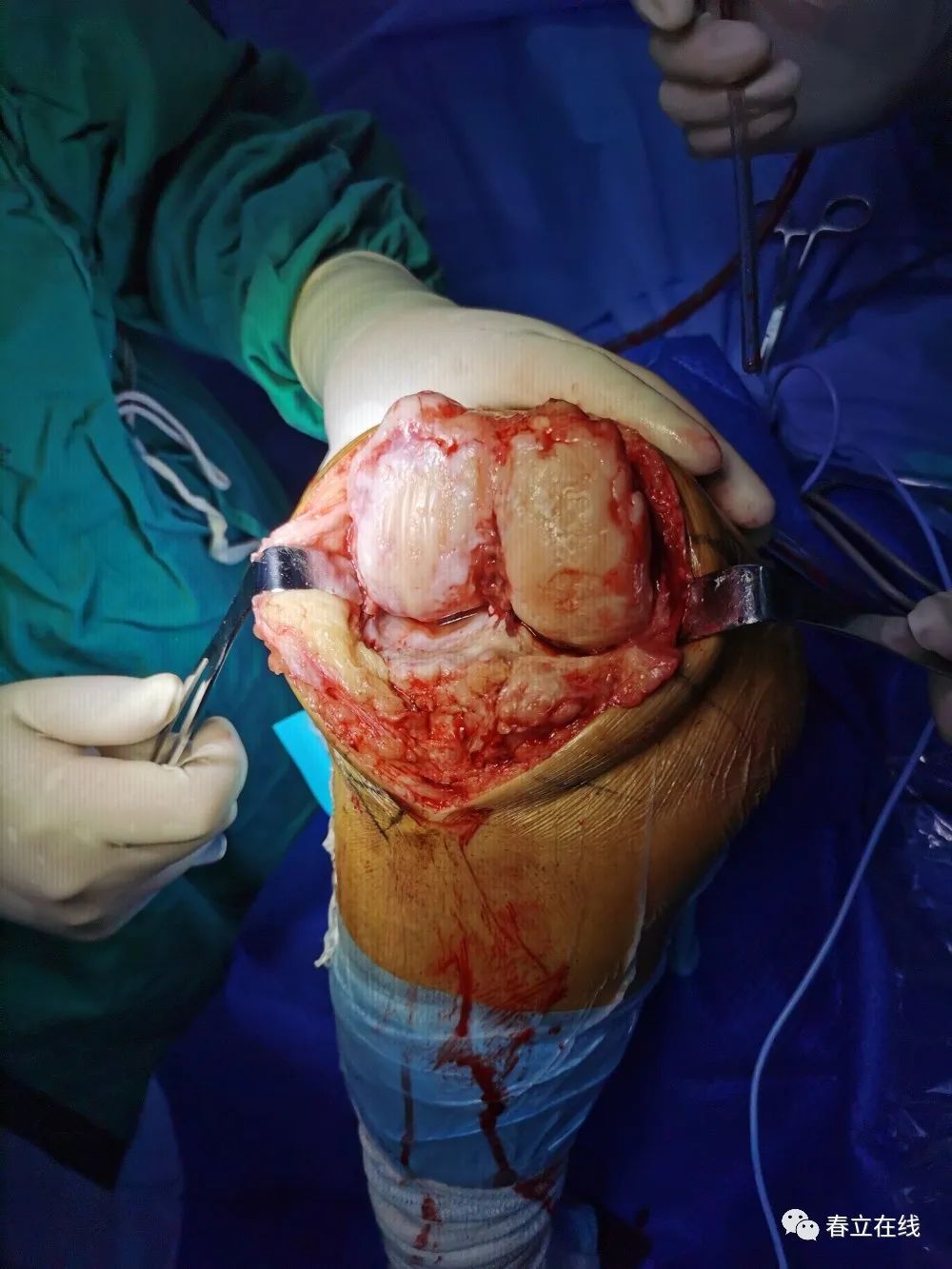 【优选病例】右侧人工全膝关节置换术(铰链膝)病例分享