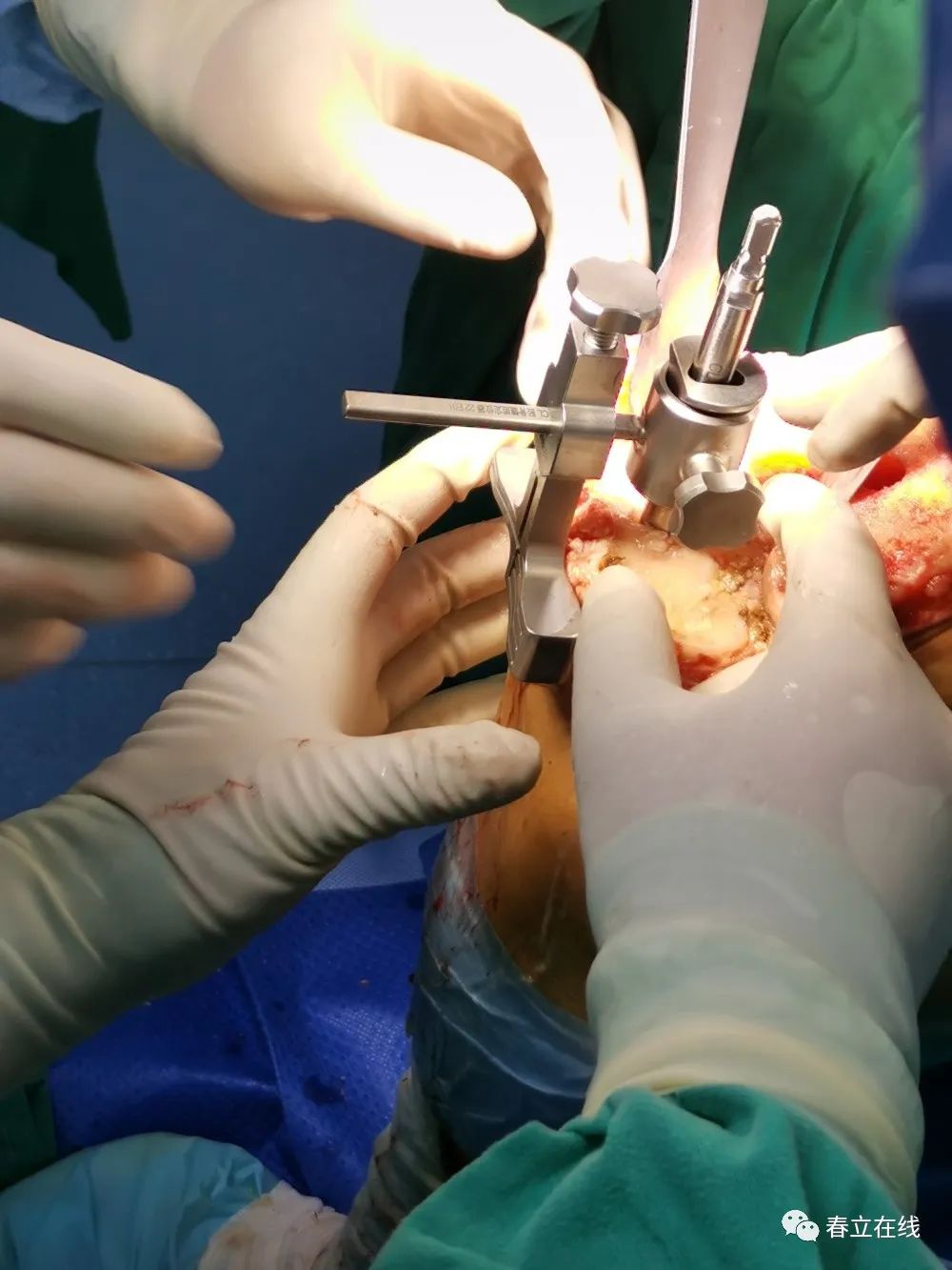 【优选病例】右侧人工全膝关节置换术(铰链膝)病例分享