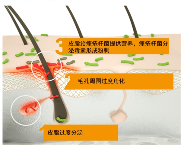 　　痘痘生成的过程