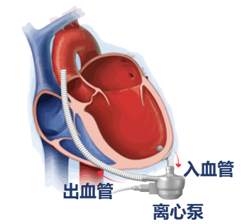 人工心脏是一种用于部分或全部替代心脏完成泵血功能,维持人体血液