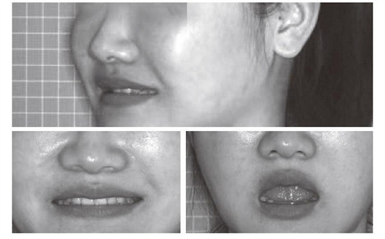 　　上图：瘪嘴示意图。