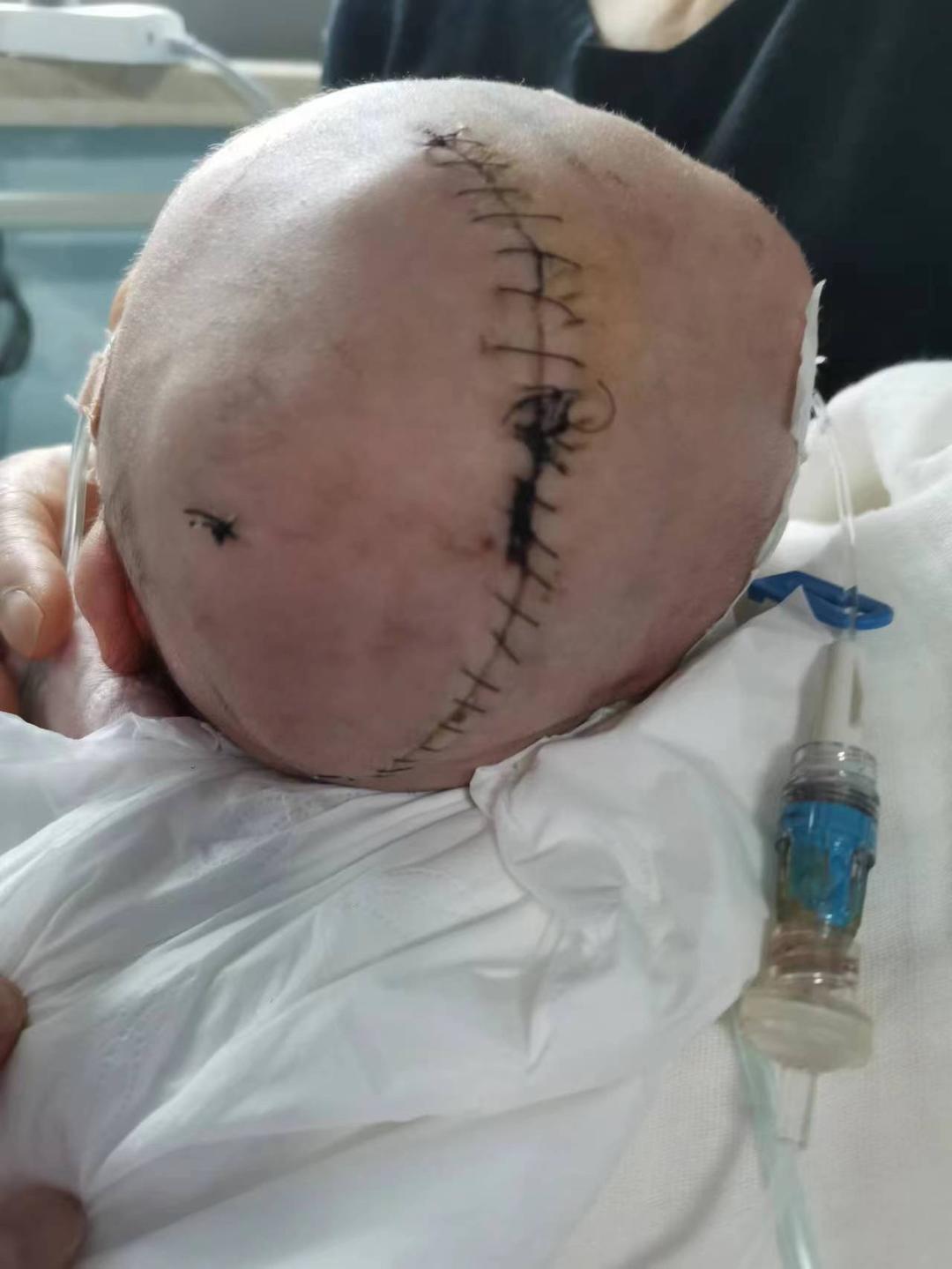 ▲开颅手术后，孩子头上留下长长的疤痕