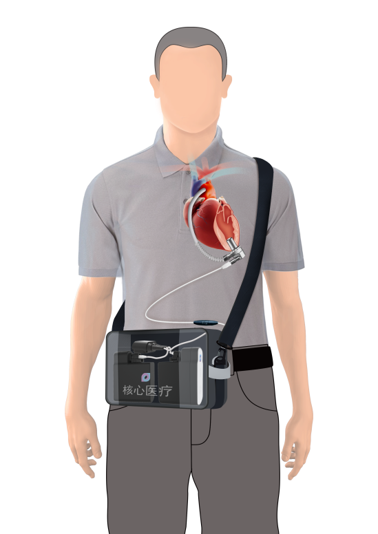 人工心脏体内、体外设备结构示意图，图源：核心医疗