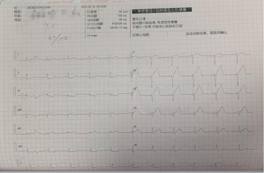 辅助检查:血生化示:心肌酶:肌酸激酶:3960 u/l↑;肌酸激酶型同工酶
