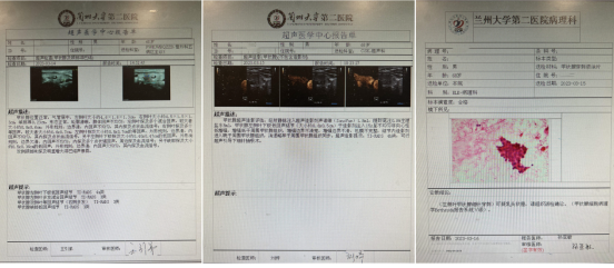 兰大二院开展经腋窝入路腔镜下甲状腺癌根治术|手术_新浪财经_新浪网