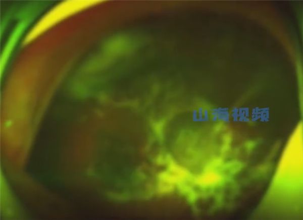 揉眼危害有多大?15岁男孩爱揉眼2次揉掉视网膜