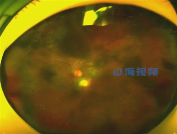 揉眼危害有多大?15岁男孩爱揉眼2次揉掉视网膜