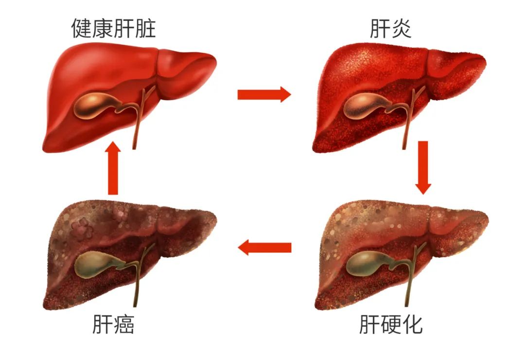 "乙肝"一定会发展为"肝癌"?如何避免很关键!|乙肝_新浪财经_新浪网