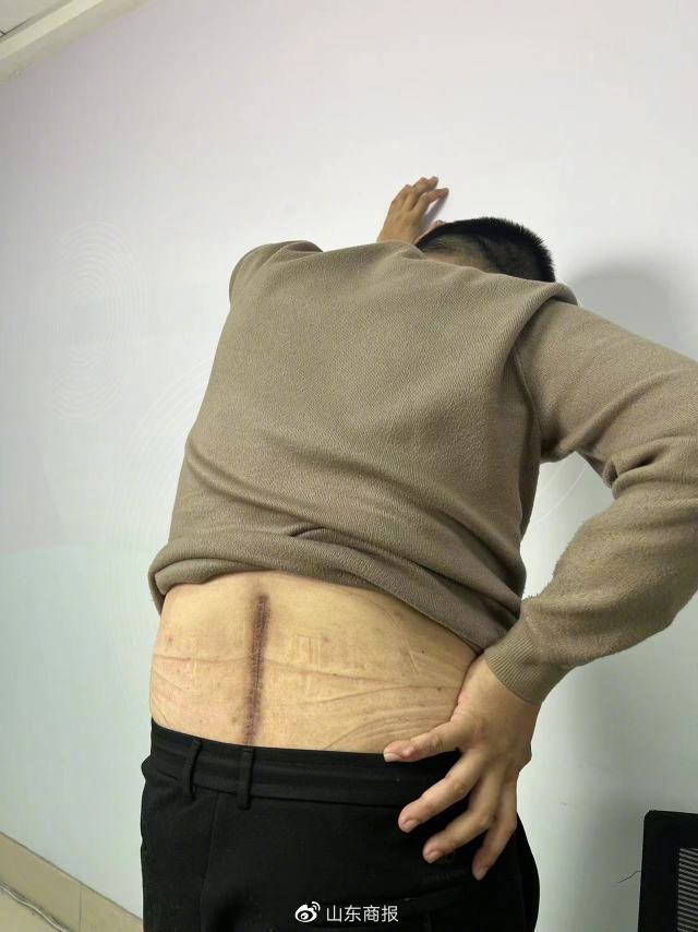 李亮后腰这道手术伤疤,时不时隐隐作痛记者 张舒 摄