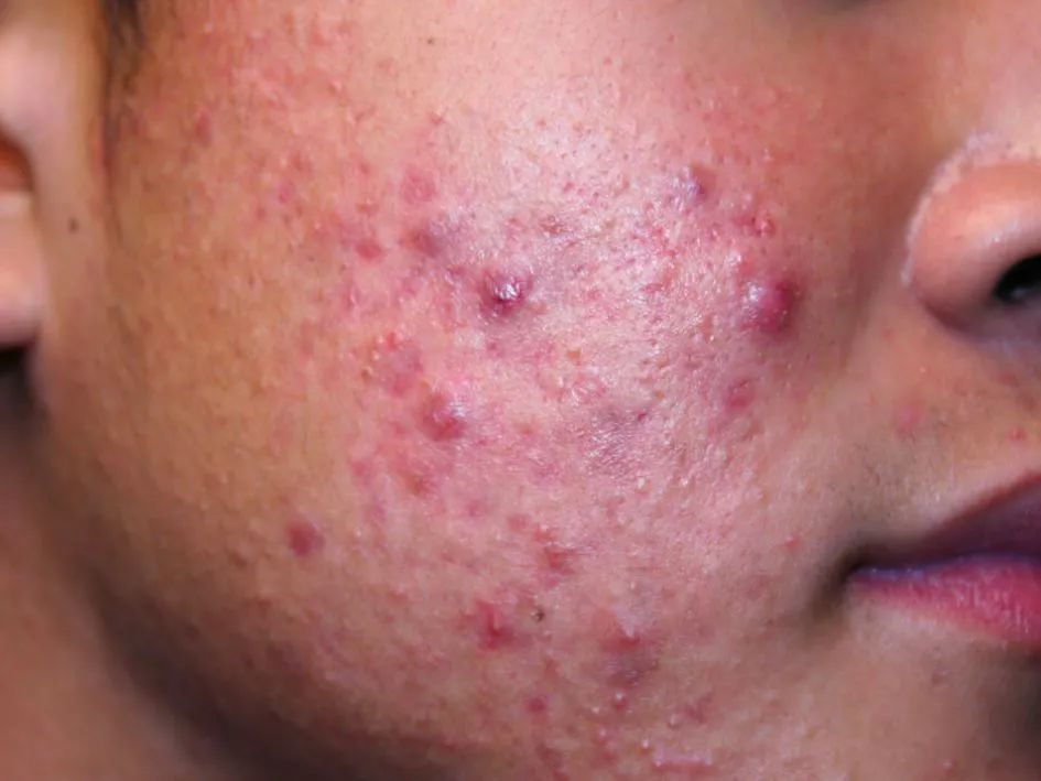 炎症性痤疮——常始于粉刺,进而扩大形成丘疹,脓疱,结节和囊肿等餐