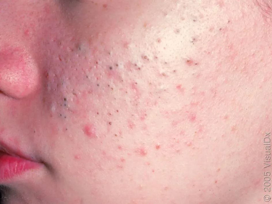 非炎症性痤疮——特征为开放性和闭合性粉刺(黑头和闭口),图片来源