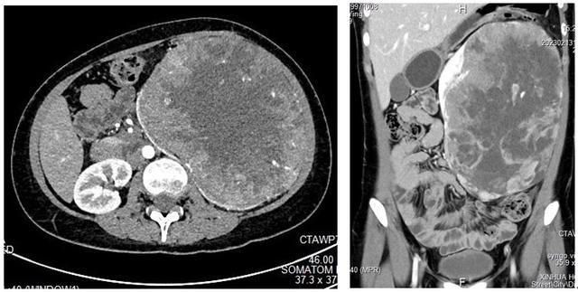 左图:左肾巨大肿瘤 (ct增强横截面)