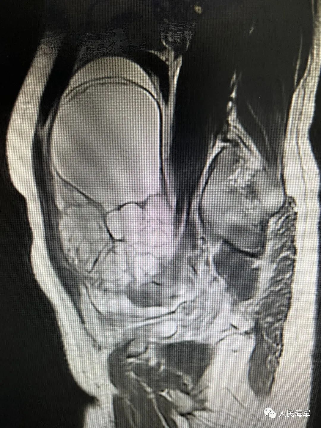▲患者盆腔MRI矢状面截图