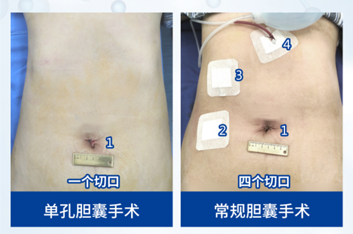 4孔变1孔,房颤患者安心接受胆囊手术:仁济医生在1.