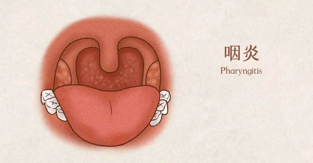 咽干,咽痛……反反复复,估计是咽炎!|咽炎_新浪财经_新浪网