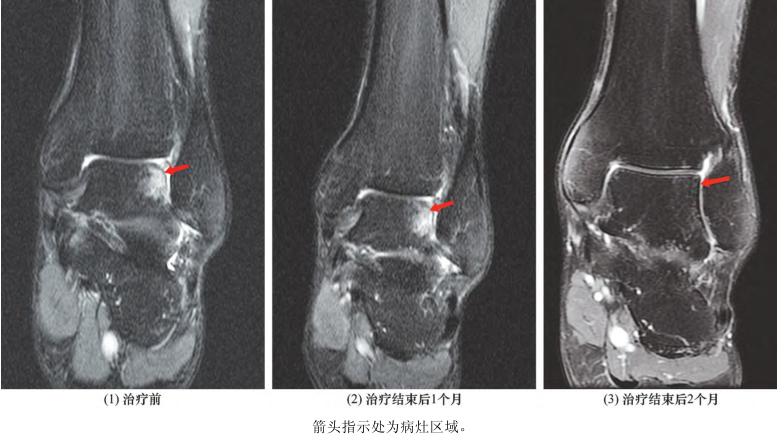 冲击波疗法治疗前后mri观察结果:治疗前,2组患者的踝关节疼痛vas评分