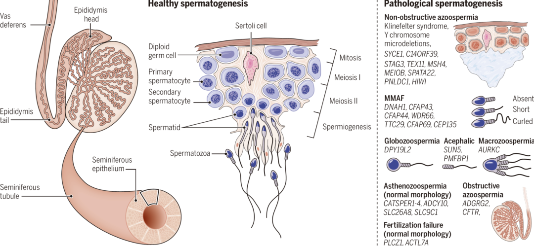 图1 不同类型精子发育异常及致病基因