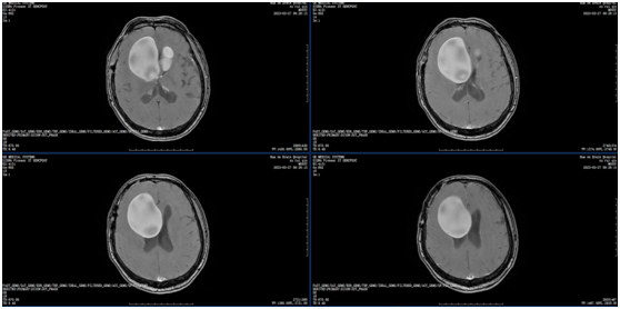 图：术前CT资料