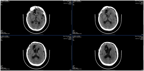 图：术后CT资料