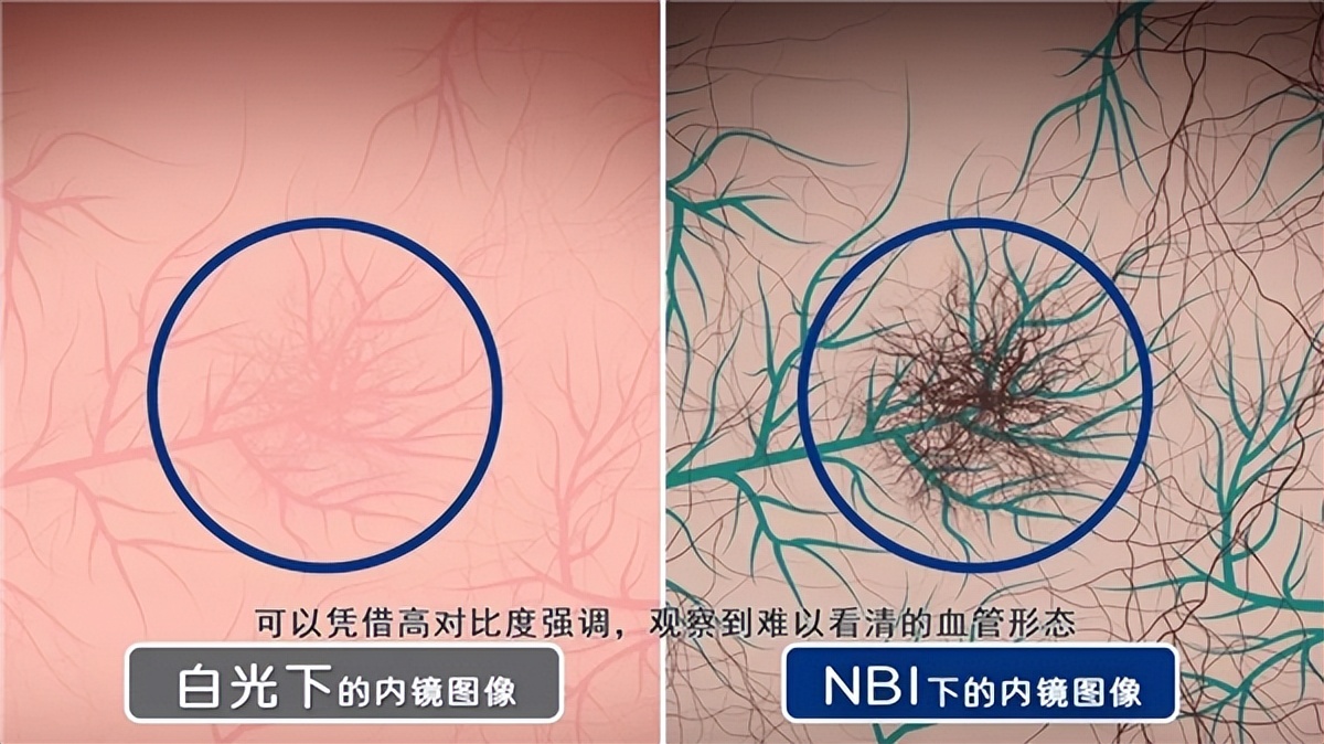 奥林巴斯窄带光成像技术(NBI)