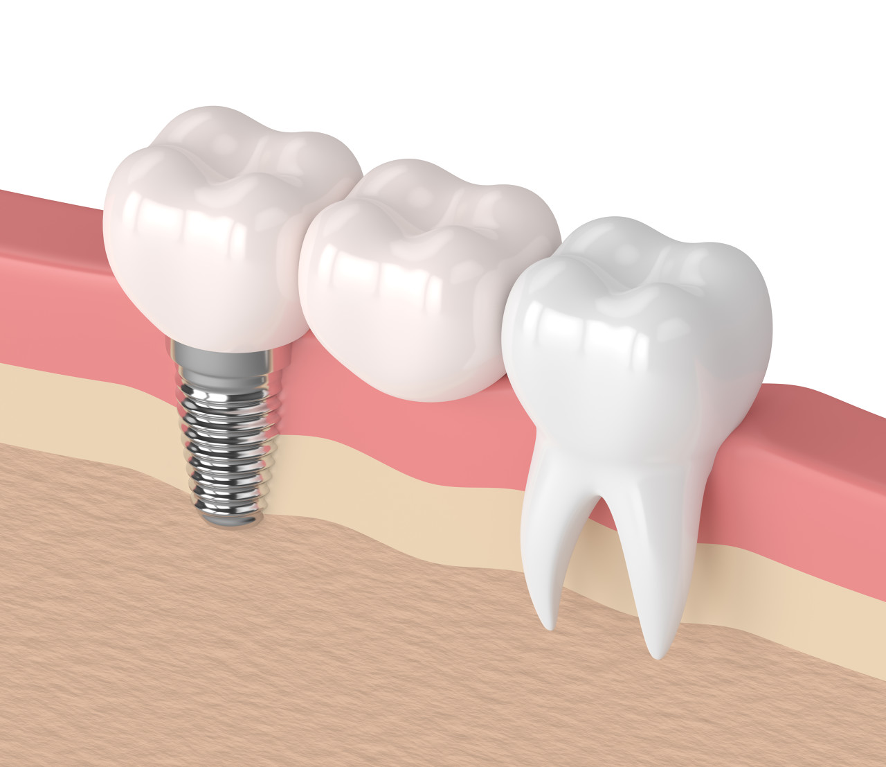 4月20日起,深圳单颗种植牙总费用降幅超50%|医疗机构_新浪财经_新浪网