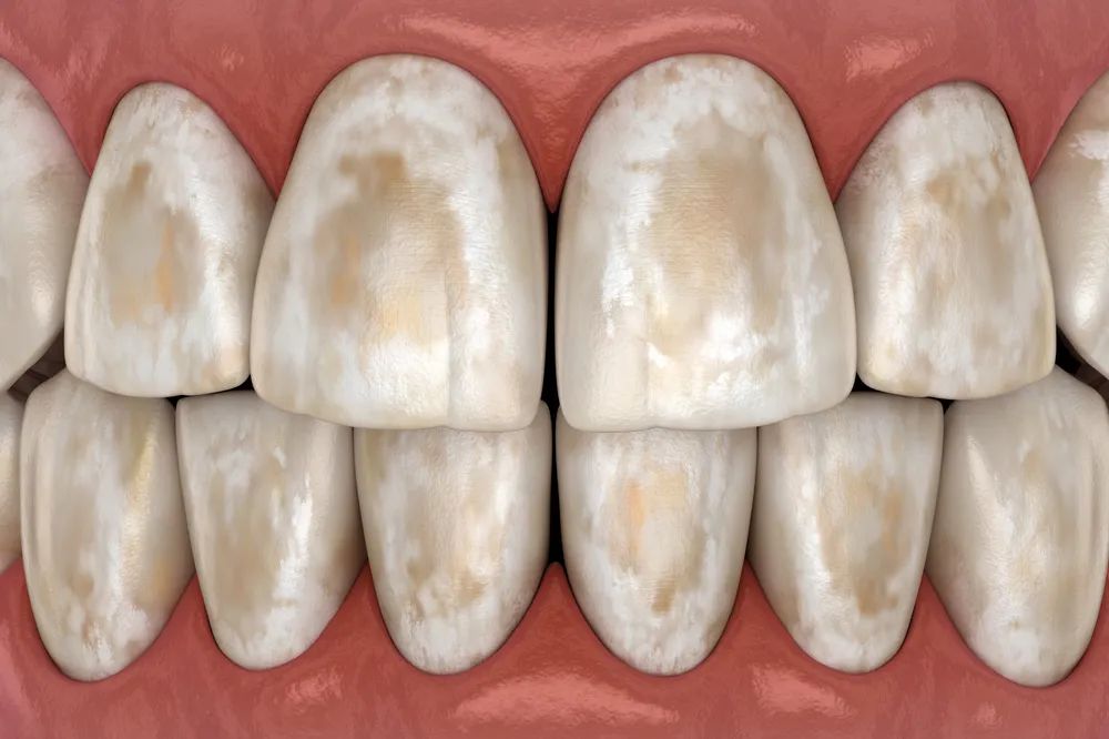 牙齿脱矿症状和图片图片