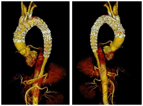 提示主动脉夹层近端破口隔绝良好,主动脉弓部分支血管血流通畅)据悉