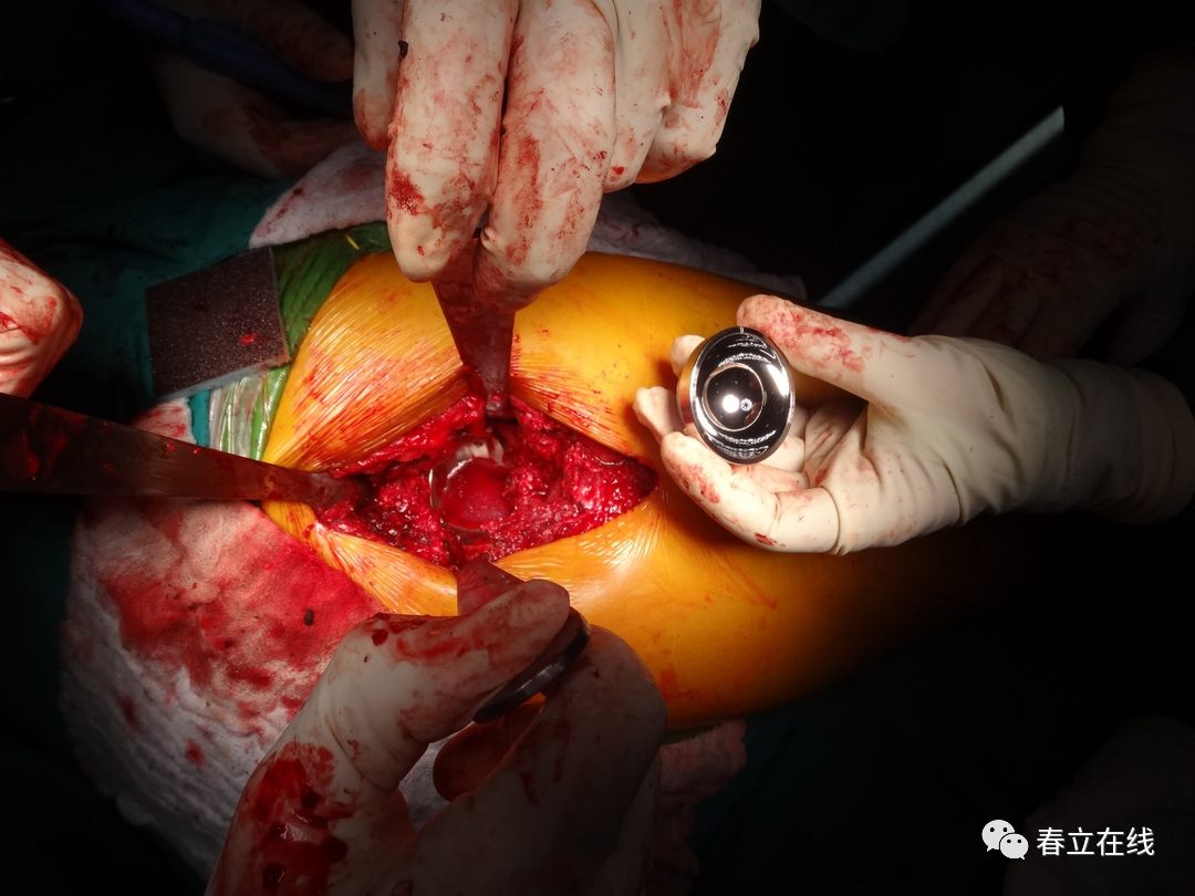 【优选病例】厄瓜多尔巧遇使用春立双动全髋患者|厄瓜多尔_新浪财经