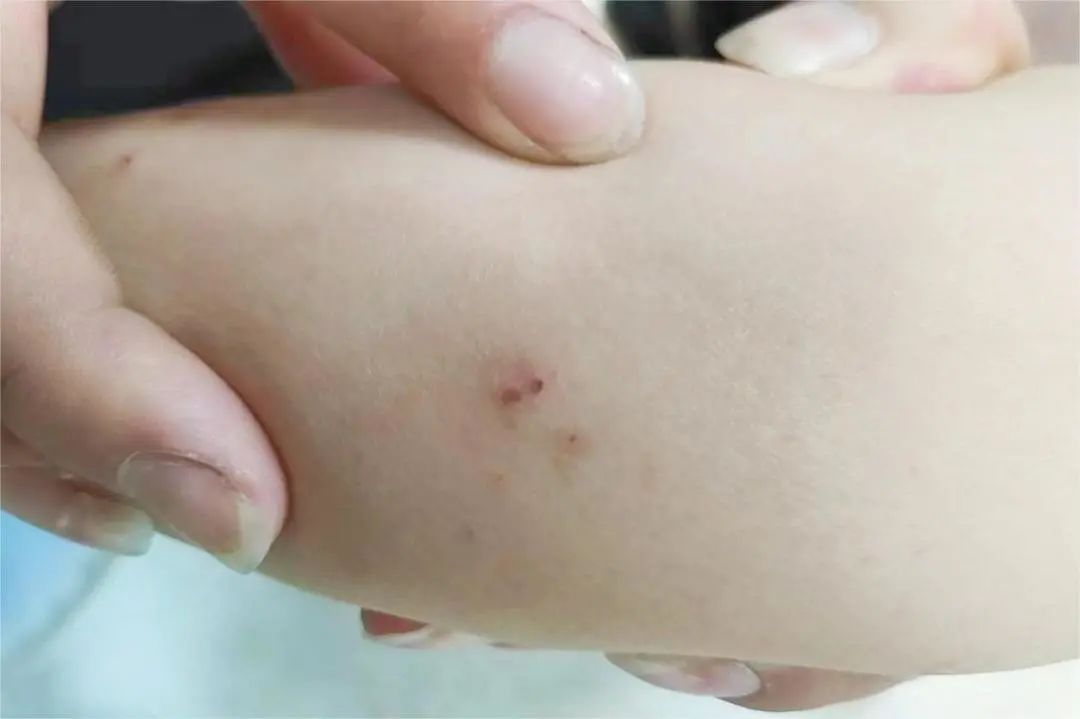 6岁男孩在家门口被咬了一口…|毒蛇_新浪财经_新浪网