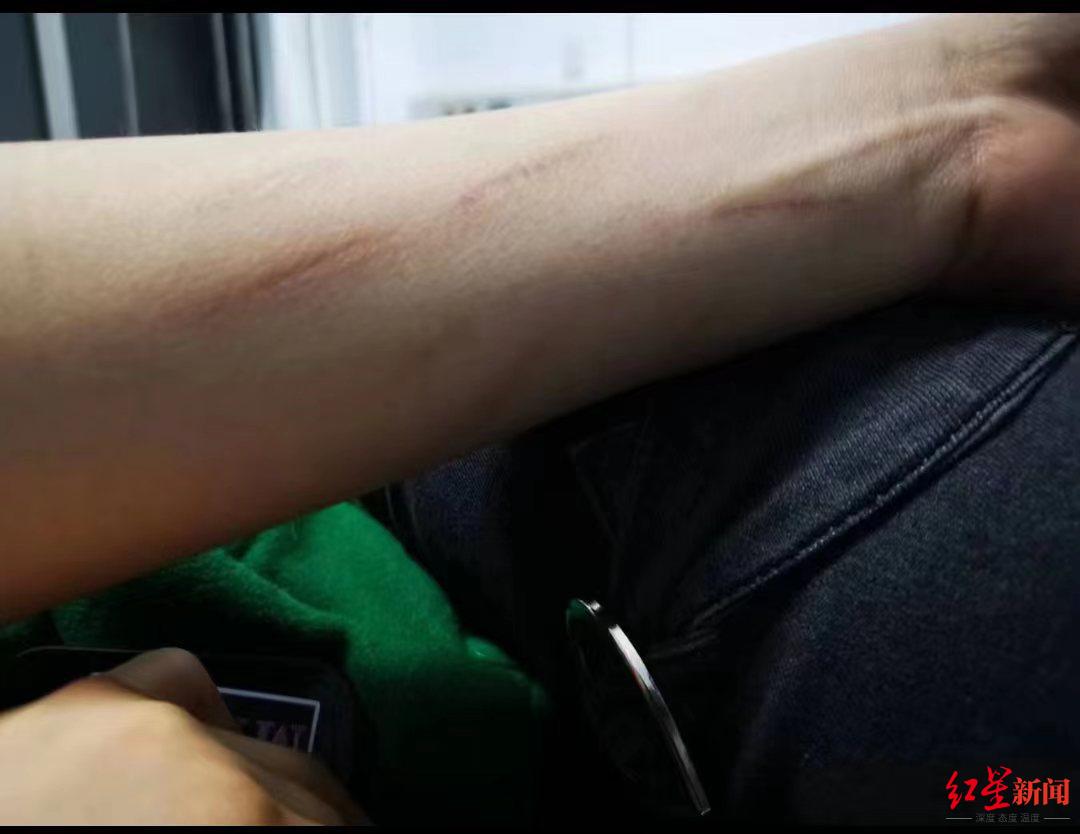 ↑4月6日，萍萍手臂上疑似有多道抓痕 受访者供图