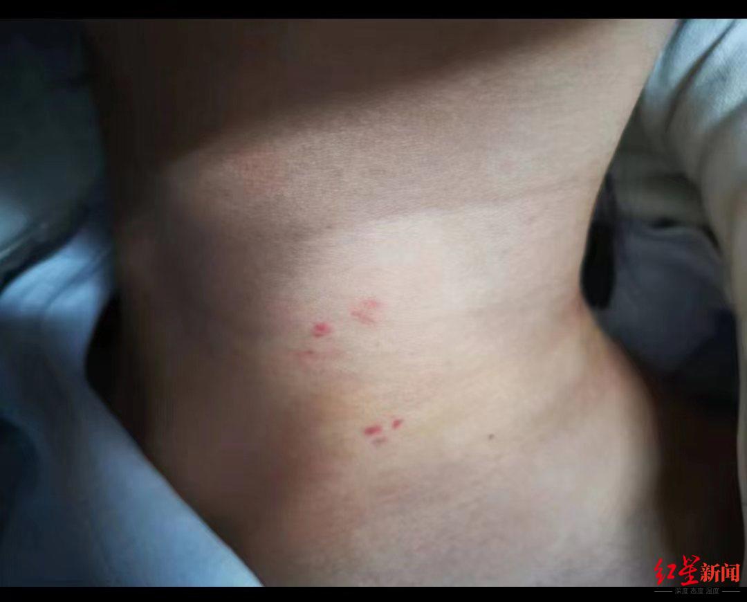 ↑4月6日，萍萍脖子上有疑似被掐的伤痕 受访者供图