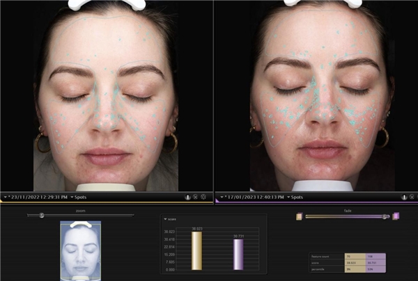 (专业皮肤测试仪器visia检测下,皮肤深层瑕疵明显减少)