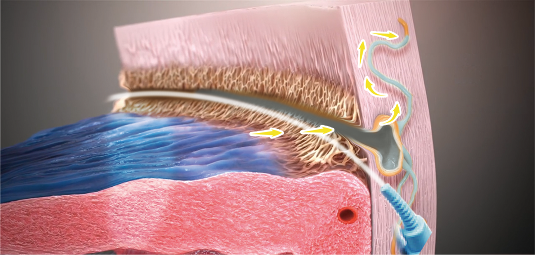 房角镜品牌有哪些太厉害了！深圳爱尔实施首例 iTrack 微导管辅助的青光眼手术让年轻女子重获光明_https://www.jmylbn.com_新闻资讯_第7张