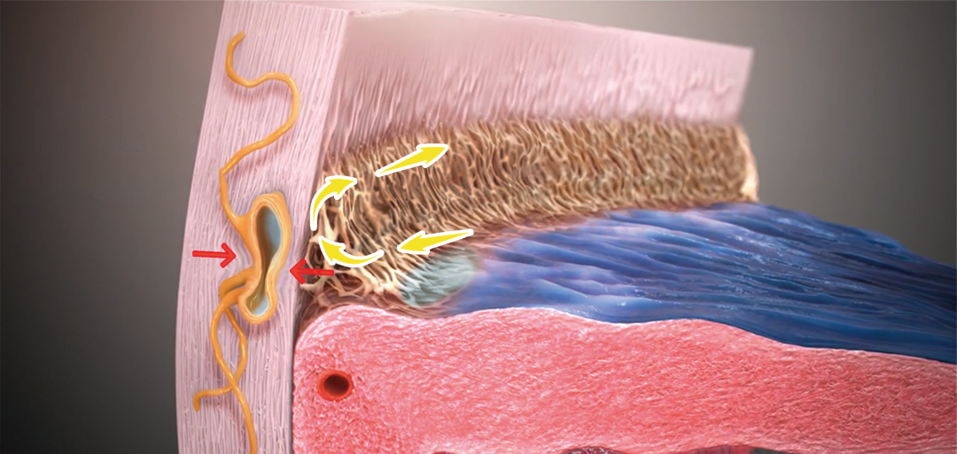 房角镜品牌有哪些太厉害了！深圳爱尔实施首例 iTrack 微导管辅助的青光眼手术让年轻女子重获光明_https://www.jmylbn.com_新闻资讯_第5张