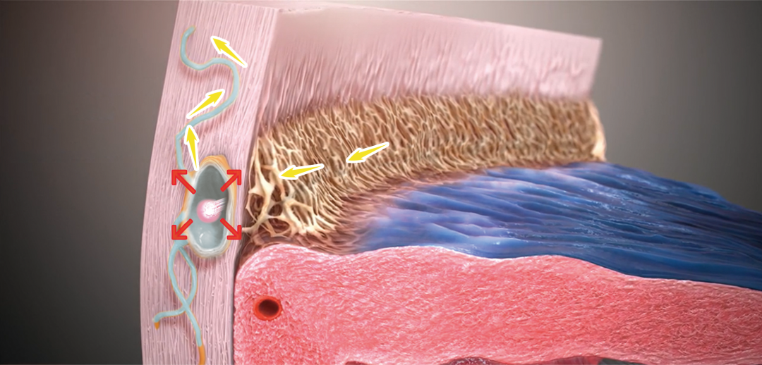 房角镜品牌有哪些太厉害了！深圳爱尔实施首例 iTrack 微导管辅助的青光眼手术让年轻女子重获光明_https://www.jmylbn.com_新闻资讯_第6张