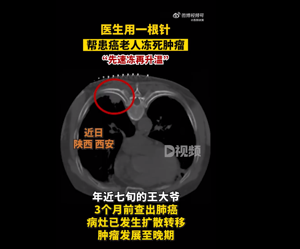 医生用一根针帮患癌老人冻死肿瘤：冷冻消融技术，先速冻再升温|肿瘤_新浪财经_新浪网