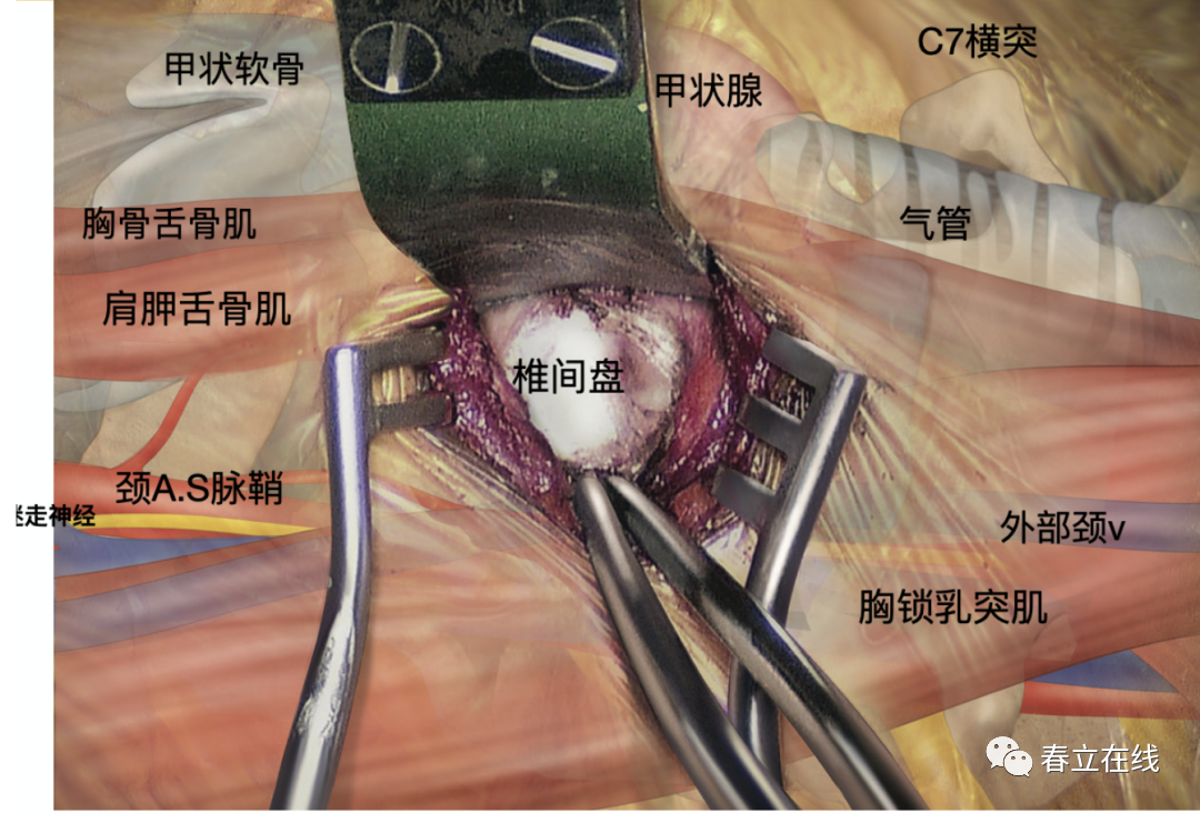 必要时切除增生肥厚的后纵韧带,减压至硬膜囊无明显受压