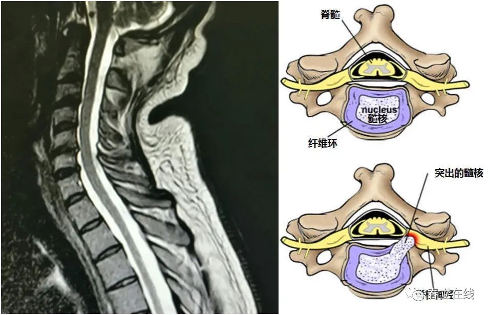 颈椎前路减压融合术|颈椎_新浪财经_新浪网